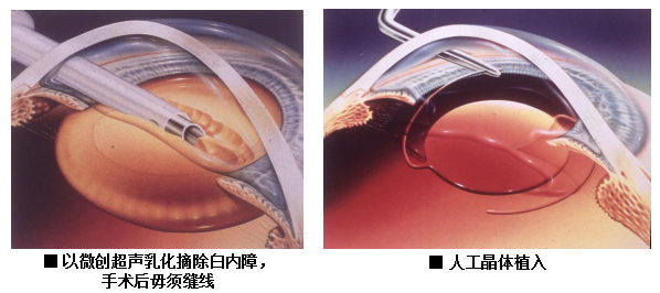 眼藥水,是,白內障,患者,的,“,救星,”,眼藥水,