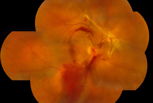 預防,致盲,性糖,網,眼病,糖尿,病患者,應注意, 預防,致盲,性糖,網,眼病,糖尿,病患者,應注意,