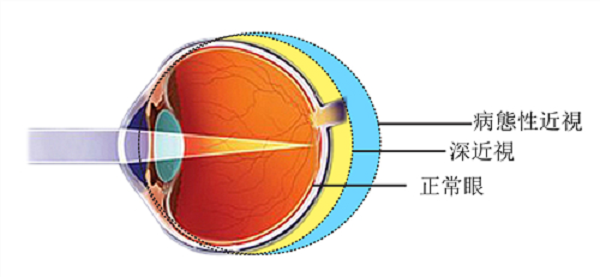 2歲,半,寶寶,近視,高達,900度,深度,者需,小心, 2歲,半,寶寶,近視,高達,900度,深度,者需,小心,