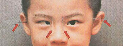 家長(zhǎng),們,注意,了,斜視,對(duì),孩子,的,影響,比你,