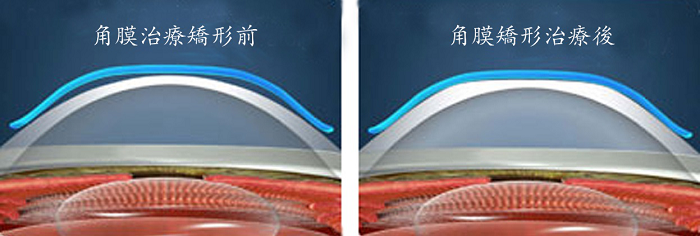 近視,低齡化,日漸,突出,看,鏡如,何來,使,進程, 近視,低齡化,日漸,突出,看,鏡如,何來,使,進程,