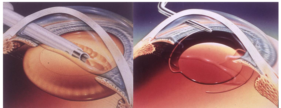 學(xué),巴菲特,每天,5罐,可樂,小心,這些,致盲,性, 學(xué),巴菲特,每天,5罐,可樂,小心,這些,致盲,性,