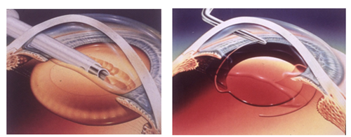 會,導致,嚴重,受損,的,三大,致盲,性,眼病, 會,導致,嚴重,受損,的,三大,致盲,性,眼病,