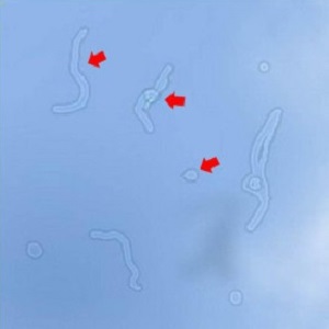 眼前,總,有小,黑影,晃動,飛蚊,癥,到底,要不要, 眼前,總,有小,黑影,晃動,飛蚊,癥,到底,要不要,