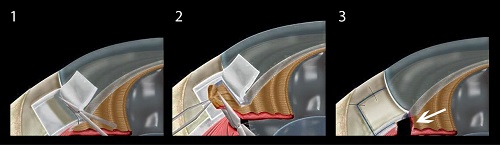 青光眼手術,青光眼復發,青光眼針刺修復