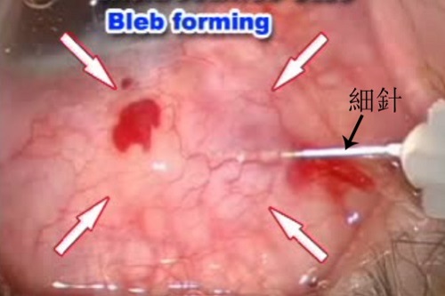 青光眼手術,青光眼復發,青光眼針刺修復