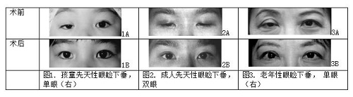 上瞼下垂怎么辦,上瞼下垂怎么治療,眼瞼下垂可以 上瞼下垂怎么辦,上瞼下垂怎么治療,眼瞼下垂可以