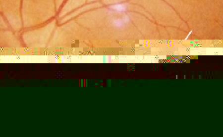 黃斑裂孔怎么辦,黃斑裂孔治療,黃斑裂孔為什么 黃斑裂孔怎么辦,黃斑裂孔治療,黃斑裂孔為什么