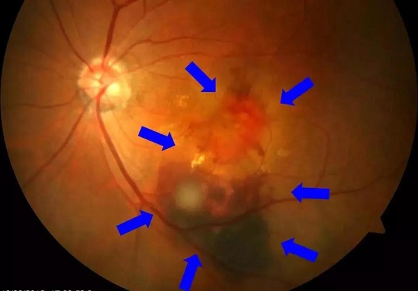 什么是黃斑變性,眼底黃斑變性,黃斑變性的治療方 什么是黃斑變性,眼底黃斑變性,黃斑變性的治療方