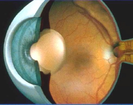 白內障什么時候治療,白內障治療時間,白內障吃藥