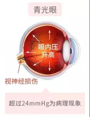 警惕,濫用,眼藥水,當心,青光眼,找上門,進入,