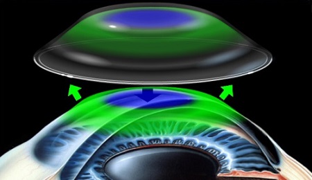 近視矯正,角膜塑形鏡原理,角膜塑形鏡有用嗎,角