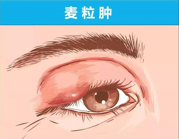 眼睛,腫,了,應該,選擇,熱敷,還是,冷敷,你, 眼睛,腫,了,應該,選擇,熱敷,還是,冷敷,你,