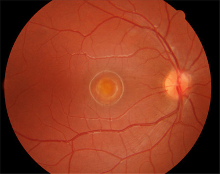 黃斑營養不良是什么,黃斑營養不良病因,黃斑營養 黃斑營養不良是什么,黃斑營養不良病因,黃斑營養