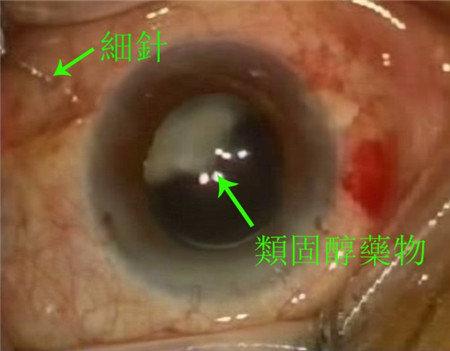 糖尿病白內障,白內障手術,白內障治療 糖尿病白內障,白內障手術,白內障治療