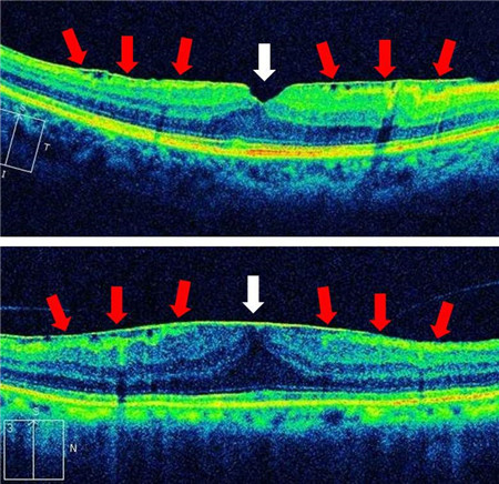黃斑前膜是啥,黃斑前膜成因,黃斑前膜治療 黃斑前膜是啥,黃斑前膜成因,黃斑前膜治療