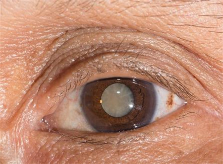 青光眼,白內障,青光眼導致白內障,青光眼白內障 青光眼,白內障,青光眼導致白內障,青光眼白內障