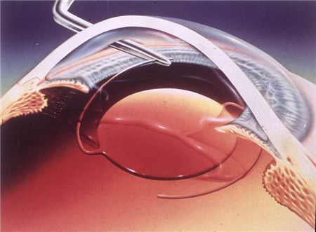 青光眼,白內障,青光眼導致白內障,青光眼白內障 青光眼,白內障,青光眼導致白內障,青光眼白內障