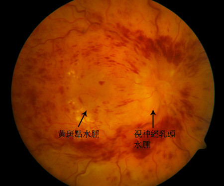眼中風(fēng),眼睛中風(fēng)怎么辦,視網(wǎng)膜中央血管阻塞,眼 眼中風(fēng),眼睛中風(fēng)怎么辦,視網(wǎng)膜中央血管阻塞,眼