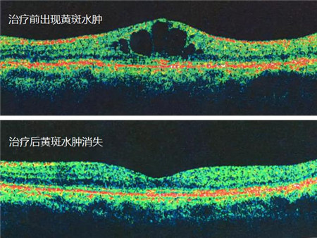 眼中風(fēng),眼睛中風(fēng)怎么辦,視網(wǎng)膜中央血管阻塞,眼 眼中風(fēng),眼睛中風(fēng)怎么辦,視網(wǎng)膜中央血管阻塞,眼