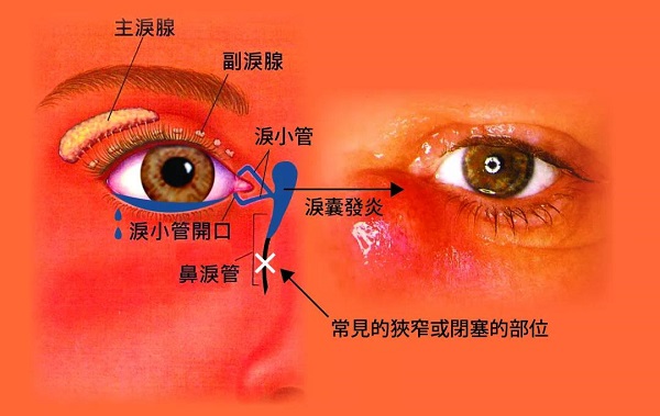 如何治療淚道病,淚道疾病癥狀,淚道病的危害