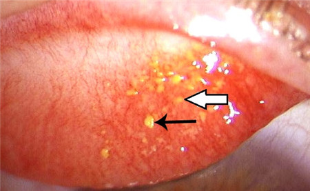 眼結(jié)石,結(jié)膜結(jié)石,眼結(jié)石治療,眼結(jié)石怎么治,眼結(jié) 眼結(jié)石,結(jié)膜結(jié)石,眼結(jié)石治療,眼結(jié)石怎么治,眼結(jié)