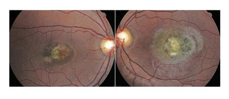 眼睛多動,眼球震顫,眼球震顫治療,兒童眼球震顫