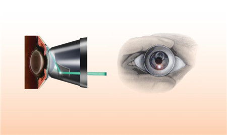 開角型青光眼,閉角型青光眼,青光眼類型,青光眼 開角型青光眼,閉角型青光眼,青光眼類型,青光眼