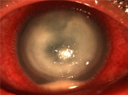 角膜潰瘍是什么,角膜潰瘍能治好嗎,角膜潰瘍治療 角膜潰瘍是什么,角膜潰瘍能治好嗎,角膜潰瘍治療