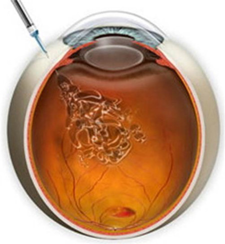 吸煙危害,黃斑退化原因,黃斑退化類型,黃斑病變 吸煙危害,黃斑退化原因,黃斑退化類型,黃斑病變