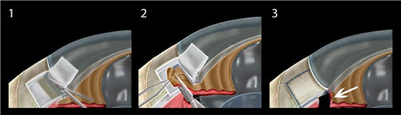 青光眼冒綠光嗎,青光眼是什么,青光眼癥狀,青光 青光眼冒綠光嗎,青光眼是什么,青光眼癥狀,青光