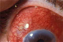 紅眼癥,鞏膜炎,鞏膜炎癥狀,鞏膜炎治療