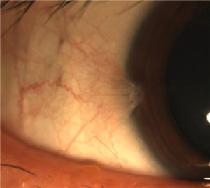 翼狀胬肉,翼狀胬肉危害,翼狀胬肉成因,翼狀胬肉 翼狀胬肉,翼狀胬肉危害,翼狀胬肉成因,翼狀胬肉