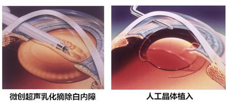 白內障要熟了才能做嗎,白內障手術什么時候做 白內障要熟了才能做嗎,白內障手術什么時候做