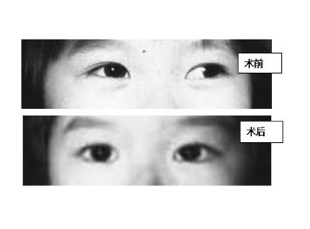 孩子斜視怎么辦,斜視的危害,小兒斜視治療 孩子斜視怎么辦,斜視的危害,小兒斜視治療