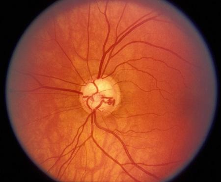 青光眼注意事項,青光眼禁忌,急性青光眼治療 青光眼注意事項,青光眼禁忌,急性青光眼治療