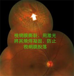 飛蚊癥,玻璃體是什么,飛蚊癥癥狀,飛蚊癥治療,飛 飛蚊癥,玻璃體是什么,飛蚊癥癥狀,飛蚊癥治療,飛