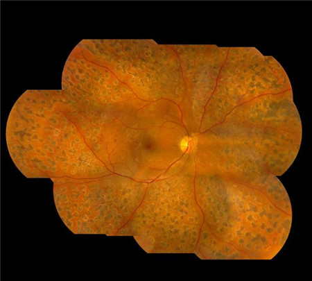 糖尿病眼底病,糖尿病視網膜病變,糖網治療 糖尿病眼底病,糖尿病視網膜病變,糖網治療