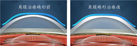 兒童近視,兒童近視的原因,近視的危害,預防近視