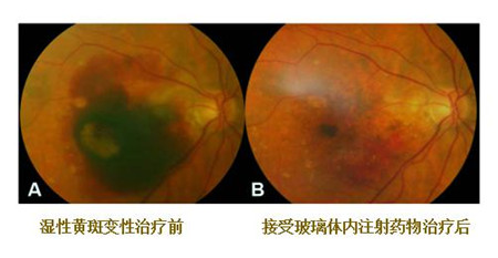 黃斑變性,致盲眼病,黃斑退化,黃斑變性治療