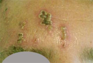 帶狀皰疹,生蛇上眼,眼部帶狀皰疹,帶狀皰疹治療 帶狀皰疹,生蛇上眼,眼部帶狀皰疹,帶狀皰疹治療