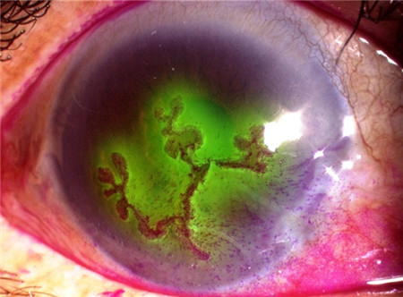 單純皰疹病毒眼病,皰疹角膜炎癥狀,皰疹角膜炎治