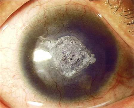 單純皰疹病毒眼病,皰疹角膜炎癥狀,皰疹角膜炎治