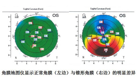 視力下降怎么辦,錐形角膜癥狀,錐形角膜如何治療 視力下降怎么辦,錐形角膜癥狀,錐形角膜如何治療