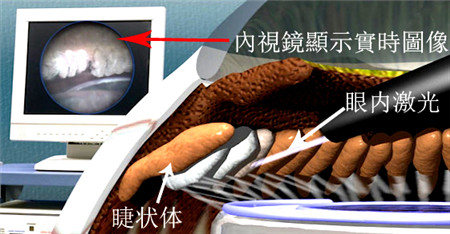 青光眼高危因素,青光眼治療,青光眼注意事項(xiàng) 青光眼高危因素,青光眼治療,青光眼注意事項(xiàng)