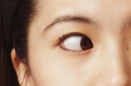 兒童斜視,小兒斜視,孩子斜視怎么辦,斜視治療 兒童斜視,小兒斜視,孩子斜視怎么辦,斜視治療