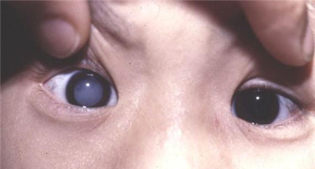 小兒白內障,孩子得了白內障怎么辦,小孩能做白內 小兒白內障,孩子得了白內障怎么辦,小孩能做白內