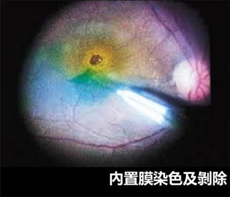 黃斑前膜是啥,黃斑前膜原因,黃斑前膜手術,得了 黃斑前膜是啥,黃斑前膜原因,黃斑前膜手術,得了
