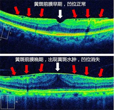 黃斑前膜是啥,黃斑前膜原因,黃斑前膜手術,得了 黃斑前膜是啥,黃斑前膜原因,黃斑前膜手術,得了