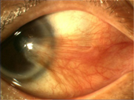 紫外線,電光性眼炎,翼狀胬肉,胬肉切除